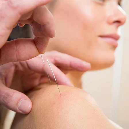 Chiropractic Breese IL Acupuncture